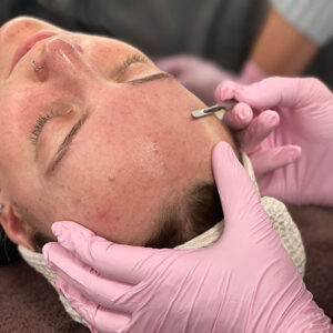 Dermaplaning forehead