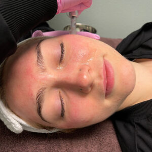 Microneedling Advanced Esthetics